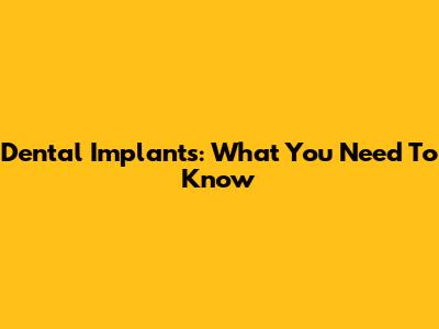 Dental Implants: What You Need To Know