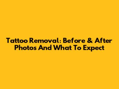 Tattoo Removal: Before & After Photos And What To Expect